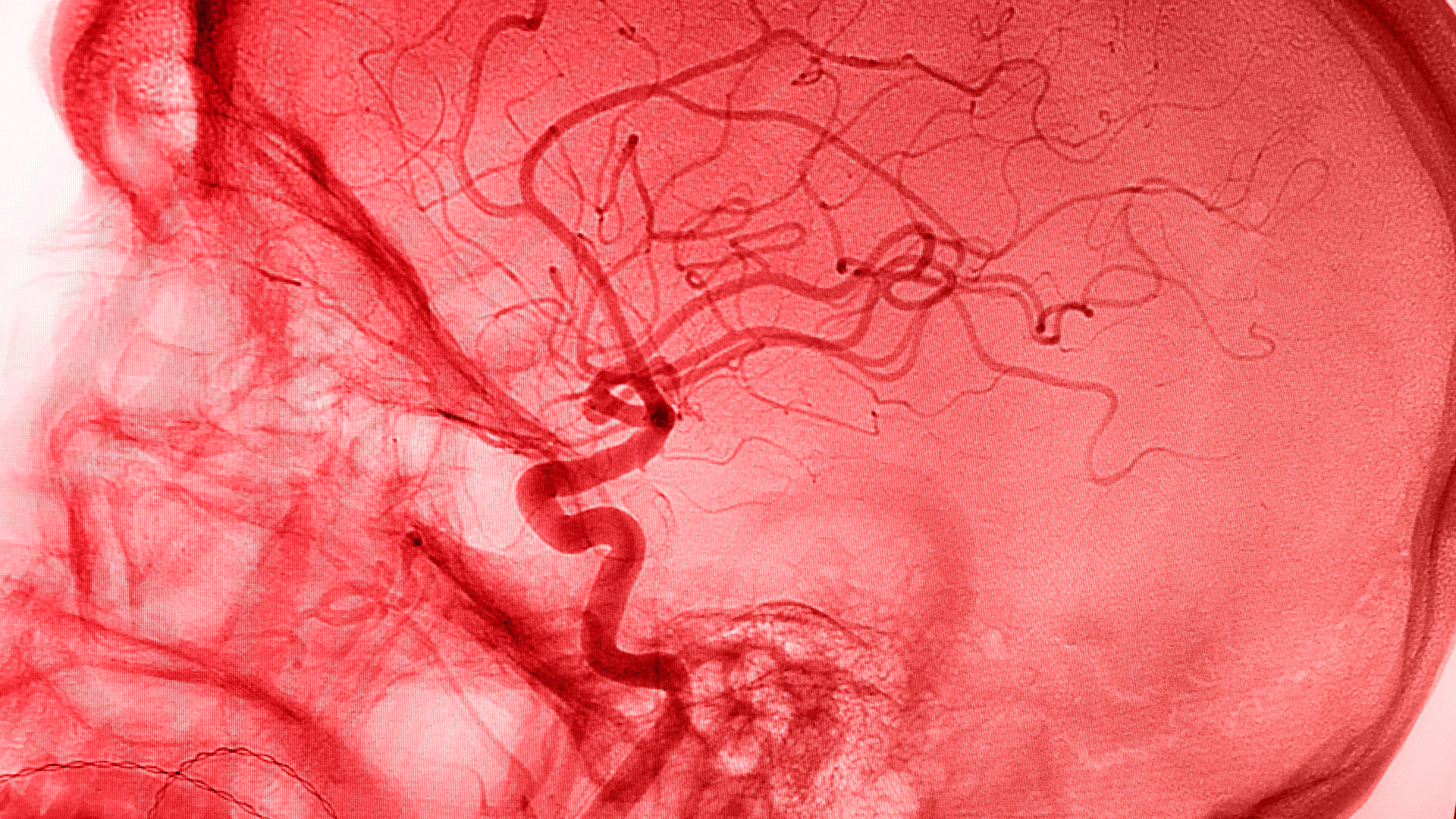 From a Brain Haemorrhage to The Broadway